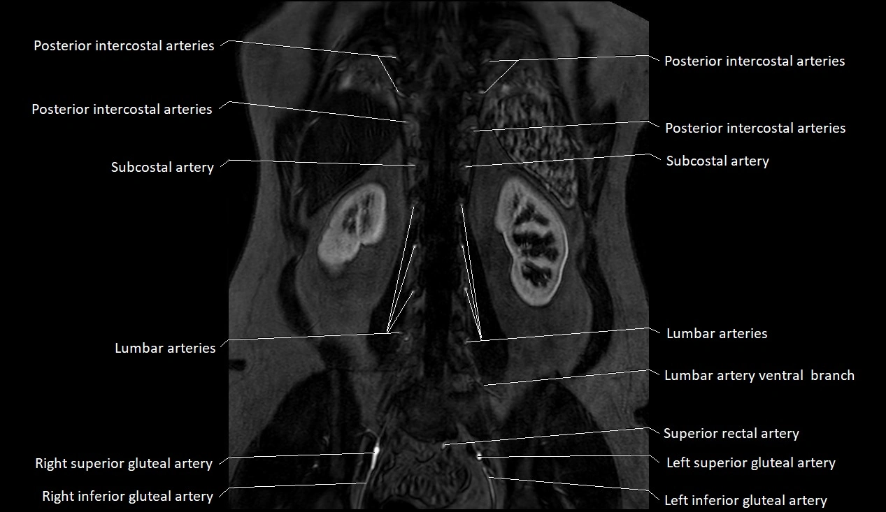 MRA Abdomen coronal anatomy image 49.webp